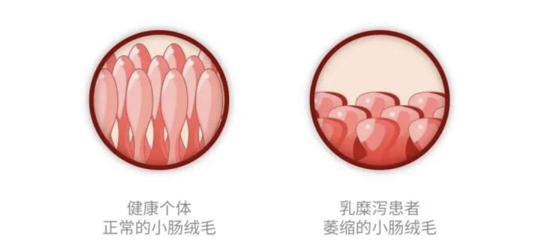 婴儿小麦不耐受肠道反应示意图