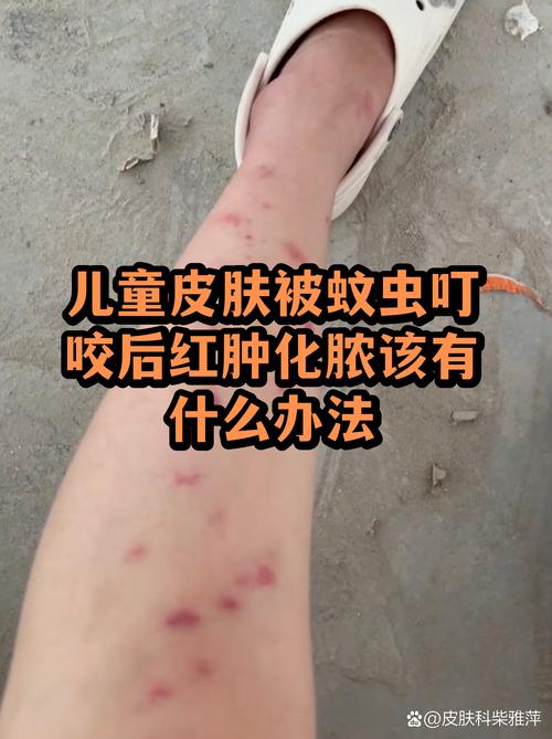 宝宝被蚊虫叮咬红肿腿部实拍
