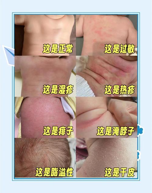婴幼儿食物过敏常见皮疹表现对比示意图