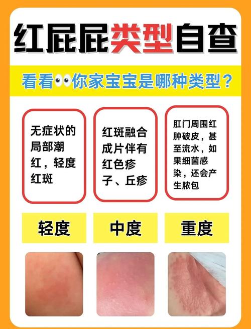 宝宝轻度红屁屁与重度红屁屁对比图