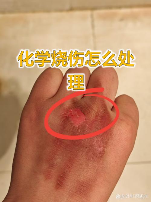 三、化学品灼伤：冲！冲！冲！