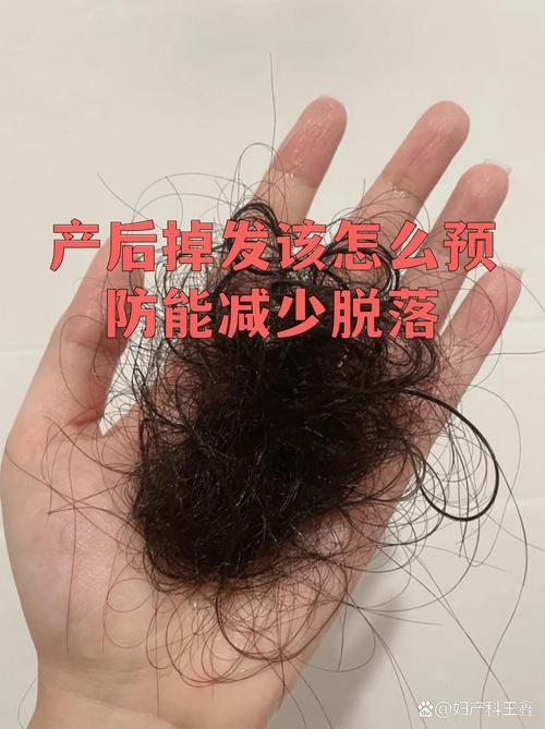 产后脱发必须就医的红线