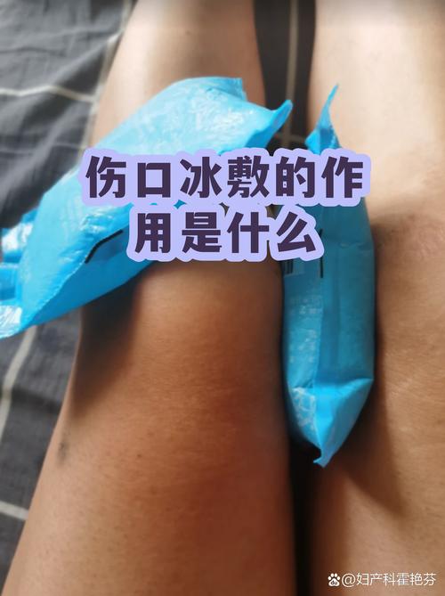 家庭轻度磕碰后冰敷处理示意图