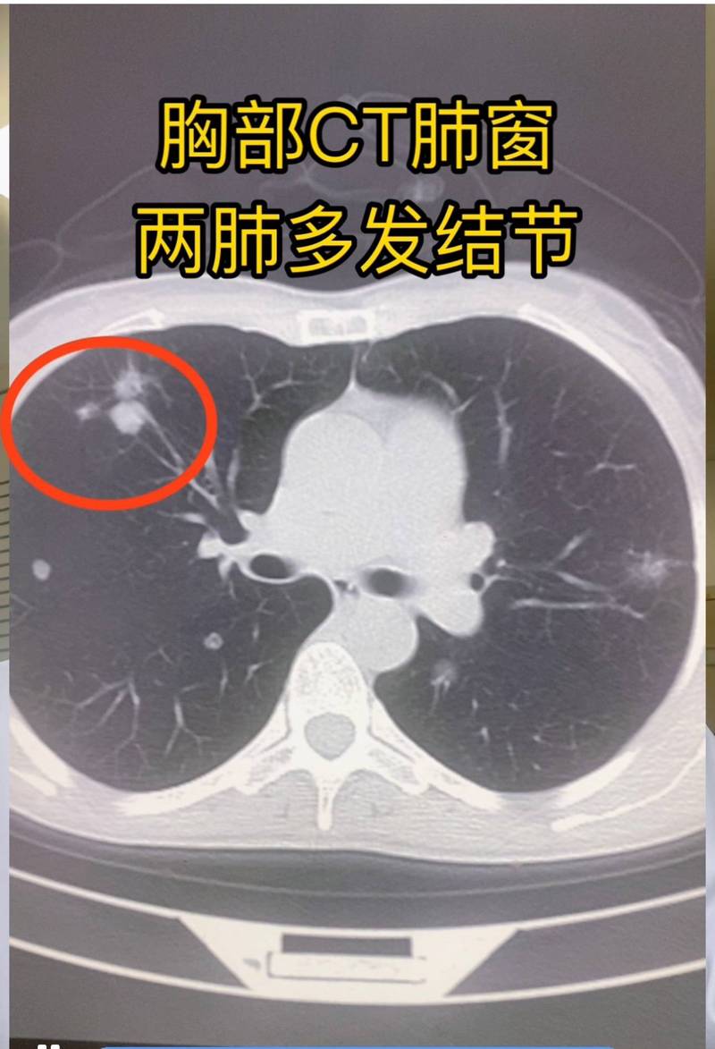 人体肺部小结节CT影像示意图