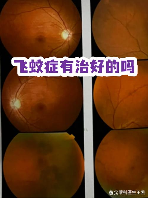 飞蚊症正常与异常眼底对比图