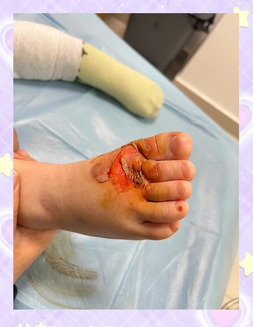 划清宝宝烧烫伤处理的就医红线