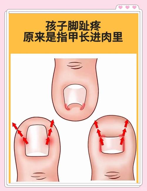 剪指甲最容易踩的几个致命错误