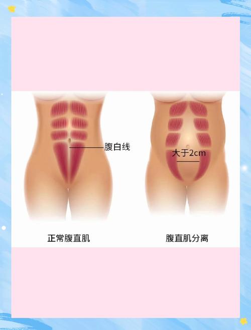 产后腹直肌分离居家自测示意图