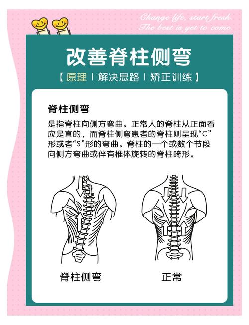 青少年不同程度脊柱侧弯对比示意图