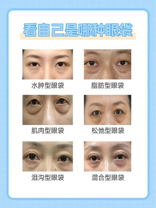 原来眼袋才是最诚实的生活记录仪