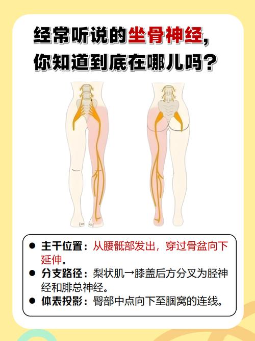 久坐时后裤袋塞钱包压迫坐骨神经示意图
