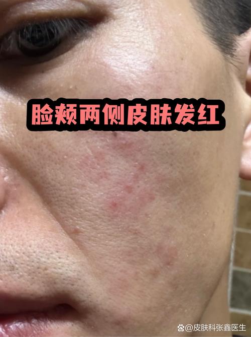 皮肤屏障受损泛红面部特写