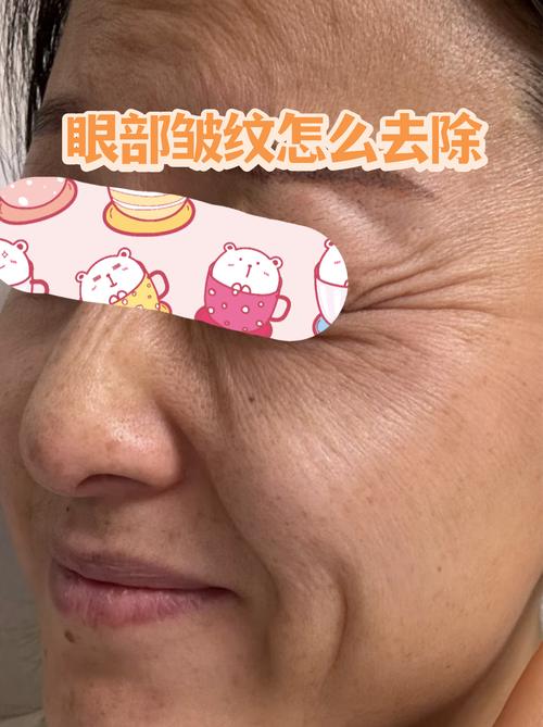揉眼睛导致眼周皱纹示意