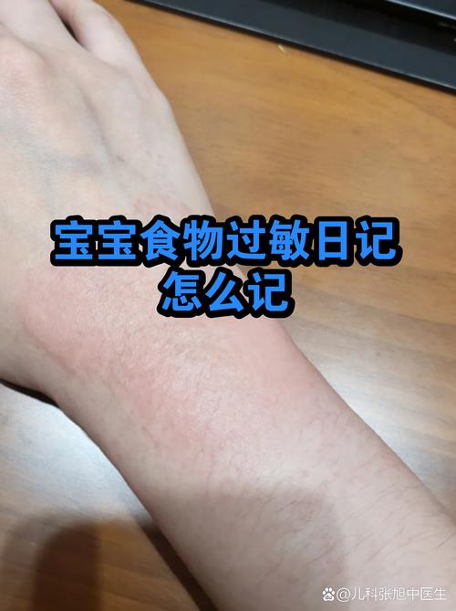 家长手写婴幼儿辅食添加过敏观察日记