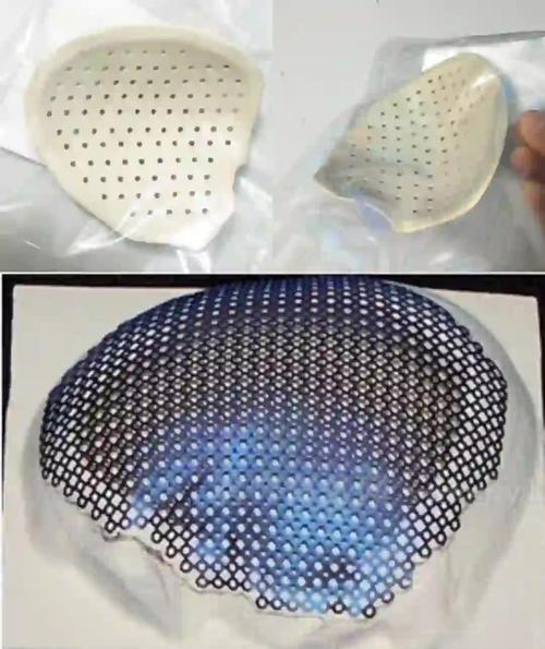 3D打印定制PEEK颅骨修复补片