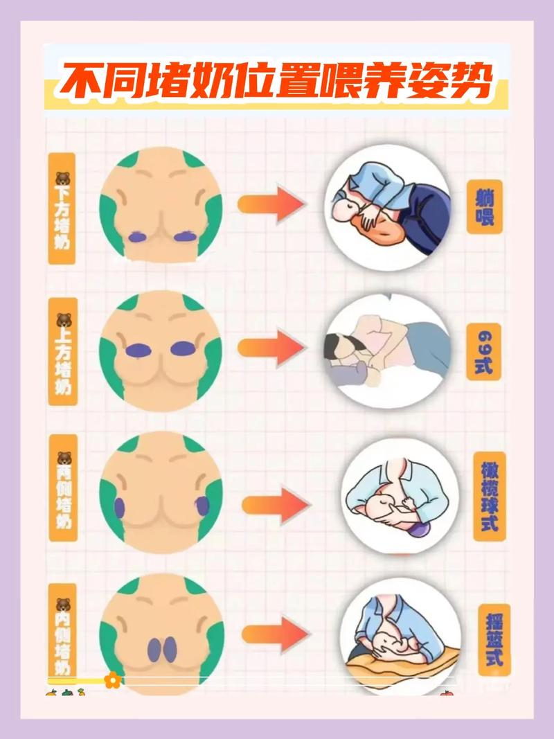 母乳喂养妈妈冷敷堵奶肿胀乳房