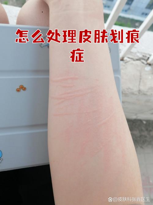 皮肤划痕症过敏测试