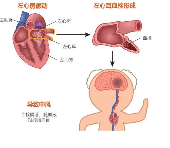 房颤患者心房血液瘀滞形成血栓示意图