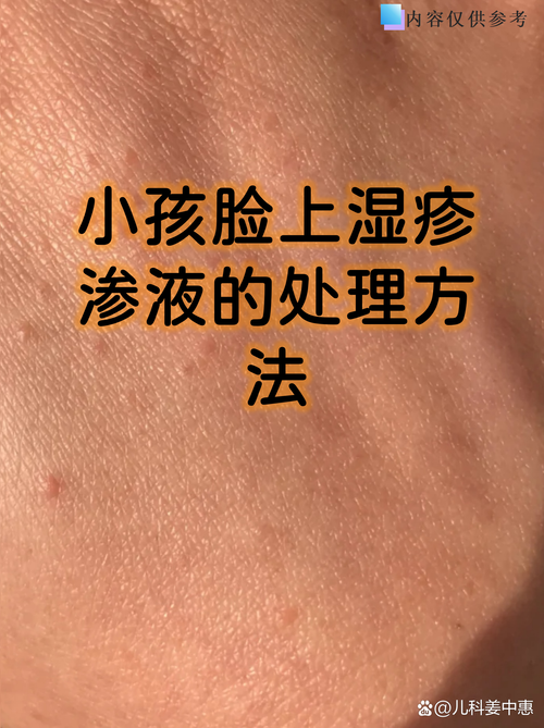儿童湿疹皮肤屏障受损示意图