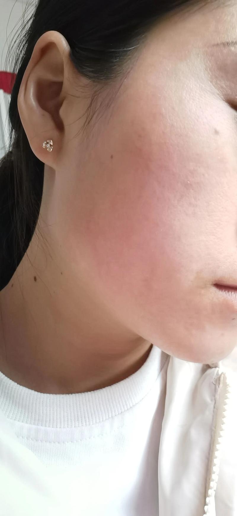 新娘过敏面部红肿近距离特写