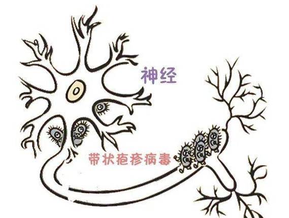带状疱疹病毒损伤神经示意图