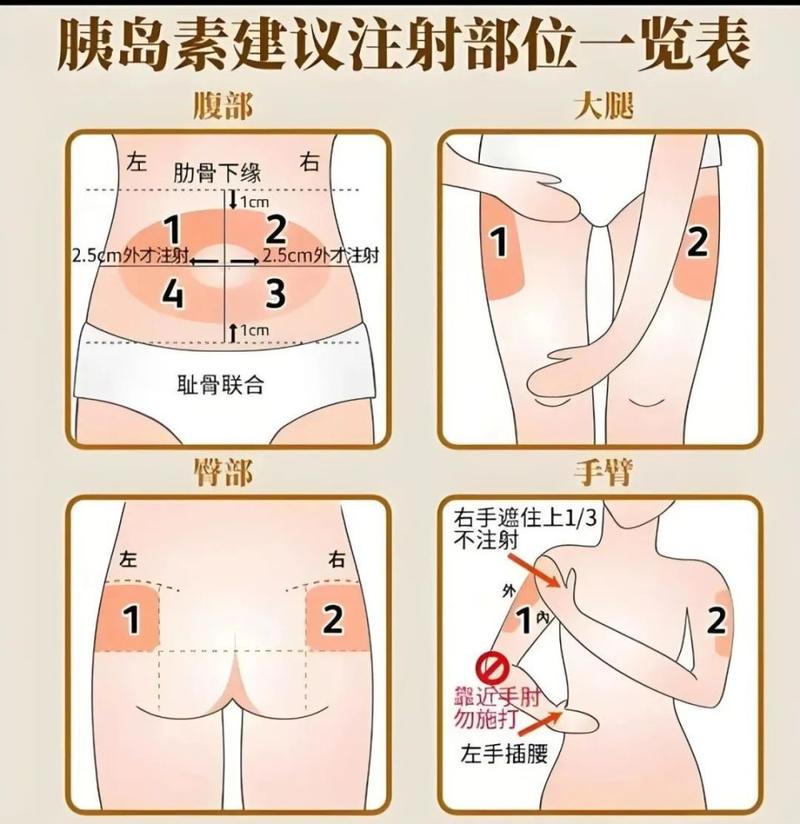 宠物糖尿病胰岛素注射正确位置示意图