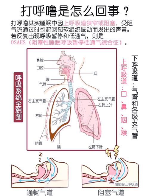睡眠打鼾气道阻塞原理示意图