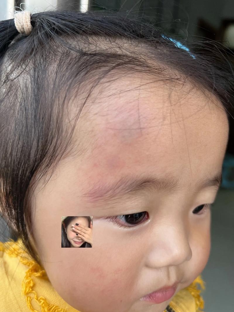 孩子头部撞到茶几角红肿