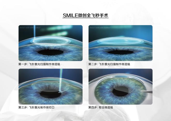 飞秒激光眼科手术示意图