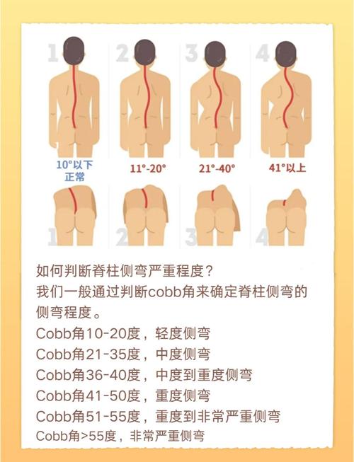青少年脊柱不同侧弯程度对比图