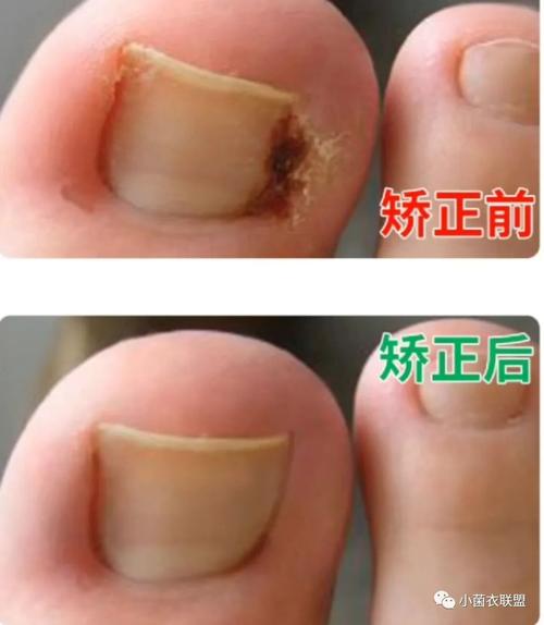 嵌甲甲沟炎症状对比图