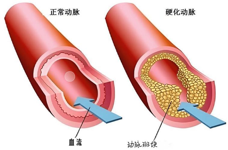 健康血管与动脉硬化血管对比示意图