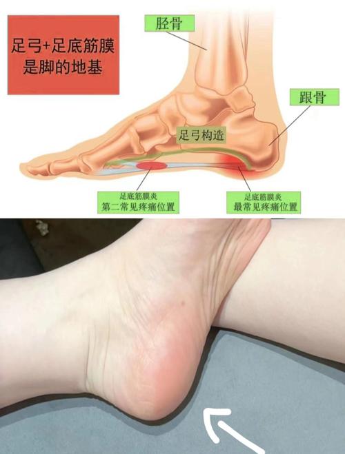 跟腱炎适配垫高足跟鞋垫结构示意图