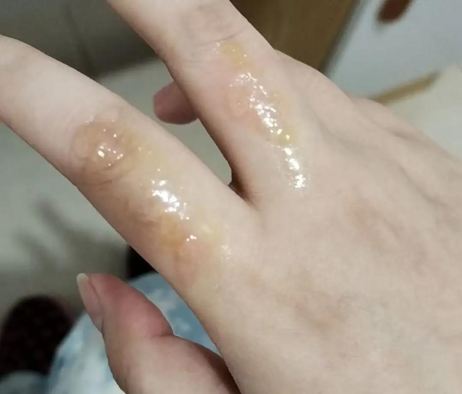 厨房里手被蒸汽烫伤的瞬间场景