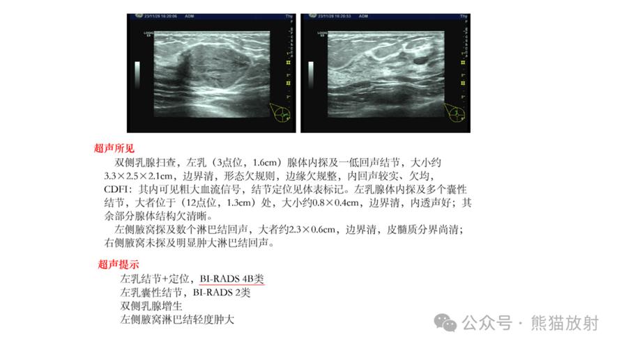 乳腺超声检查报告结节分级图