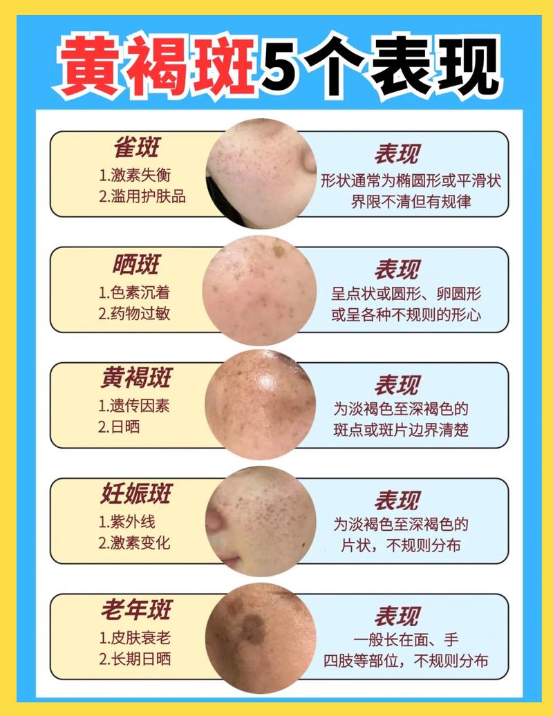 产后生理性黄褐斑分级对比示意图
