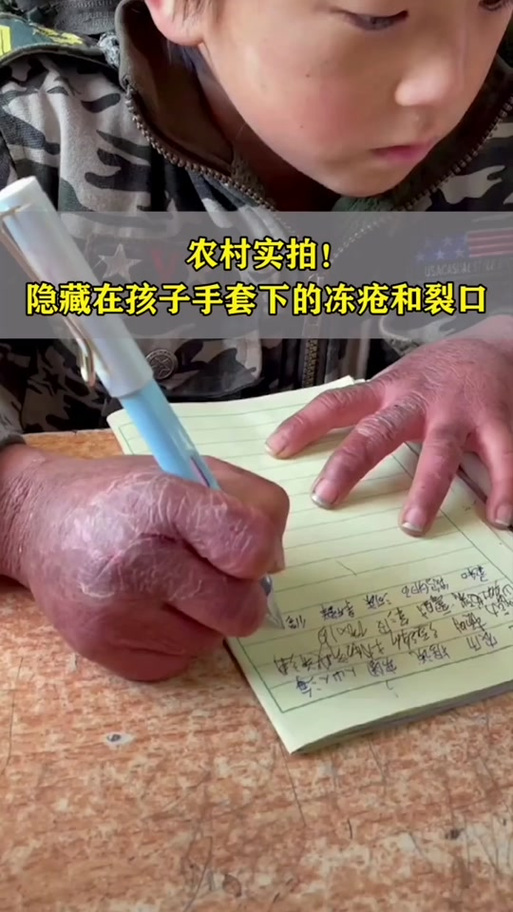 徒步登山杖错误使用导致手部磨损的案例