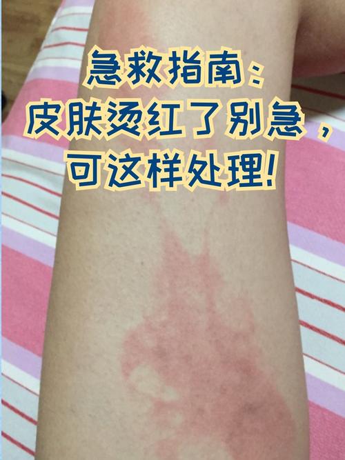 暖宝宝低温烫伤皮肤发红示例