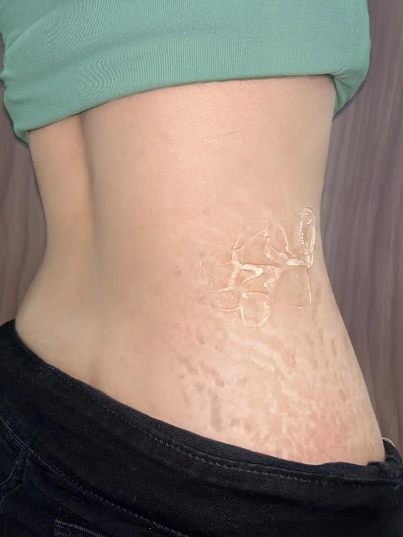 产后妈妈松弛腹部与妊娠纹近景