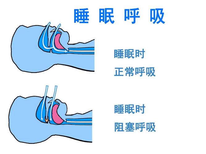 正常气道与睡眠呼吸暂停气道对比示意图