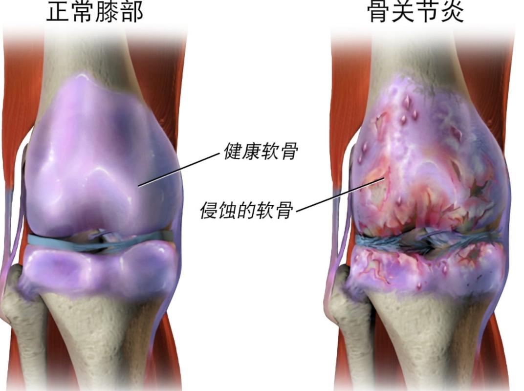 膝关节骨关节炎上下楼受力对比图
