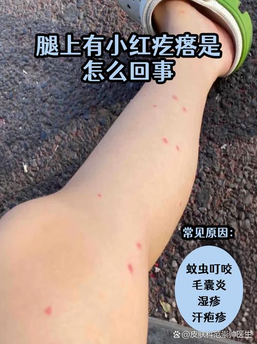 夏日山林徒步裸露腿部蚊虫叮咬红包