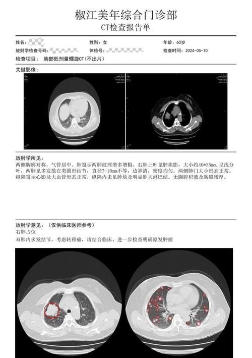 年度体检胸部CT肺结节检查报告示例