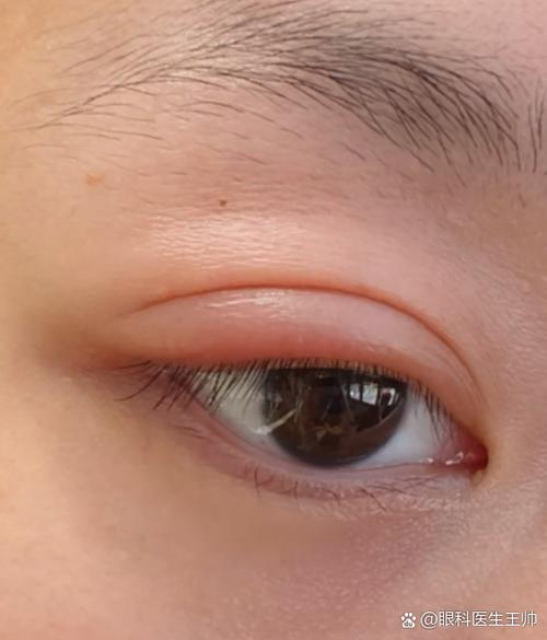 平躺一晚后晨起眼部水肿对比图