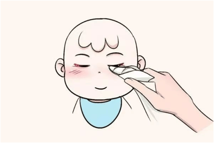 新生宝宝眼部分泌物清洁操作实景图