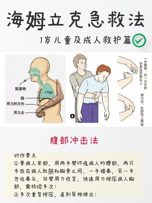 成人气道异物海姆立克急救法示意图