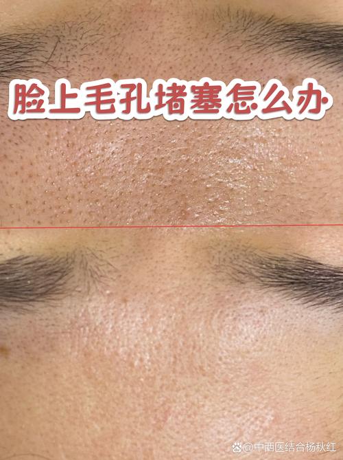 带妆过夜后毛孔堵塞状态示意图