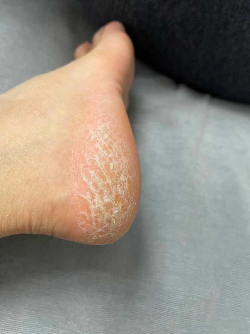 脚后跟干裂？别光知道去死皮