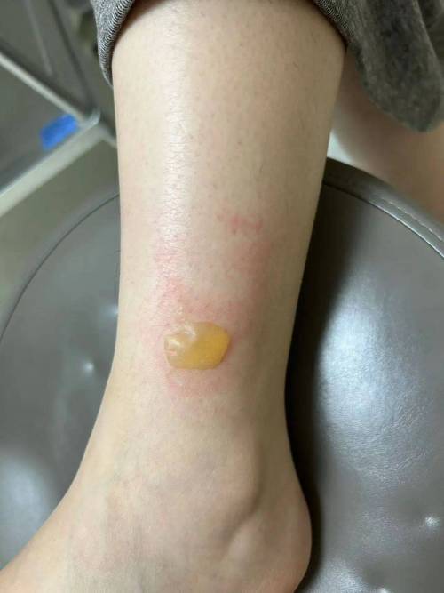 冬季门诊低温烫伤后小腿水泡实拍