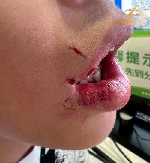 唇部基础护理,你可能一直在犯错-仁者医
